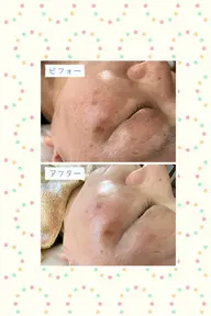♦️美白重視♦️マイルド美肌フェイシャル６０分（乳酸ピーリング+導入+マッサージ+パック）