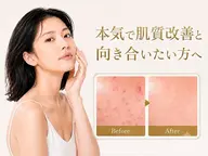 【肌荒れ/繰り返すニキビに☆】剥離ありのハーブピーリング×パック