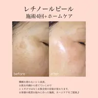 ミニモ限定価格【シミ/シワ/毛穴】何をしても効果を感じれなかった肌の深いお悩みに！オイルデコルテ/肩/首マッサージ付き♪