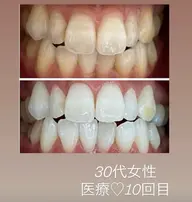 歯科提携ホワイトニング都度払い45分照射（15分×3照射）🦷🩵