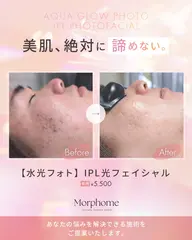【水光フォト🫧|韓国肌管理】IPL光フェイシャル+超音波毛穴洗浄