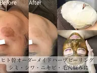 【シミ特化◎】ハーブピーリング【剥離なし】天然100%国産ハーブ×ヒト幹細胞・植物幹細胞配合