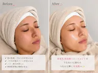 水光生美容液×ピーリング