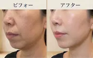 【食いしばりによる輪郭崩れ　たるみ改善】小顔＆フォト光ケア