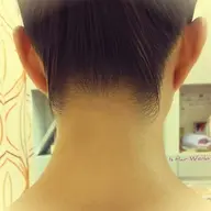 部分脱毛