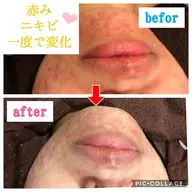 圧倒的結果(人気No.2✨ニキビ ・毛穴に効果大💖温泉みつろうフェイシャル)＋　(肩・デコルテ マッサージ) 💎✨