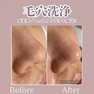 【頭皮までゴッソリ‼️】黒ずみ・皮脂・角栓撃退‼️水素水ハイドラ毛穴洗浄✨《炭酸パック付き🫧》
