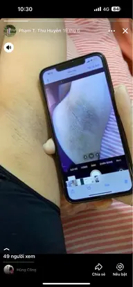 脇脱毛