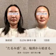 📸写真🫶月5名限定🫶ミニモ限定|リフトアップ・左右差・エラ張り改善◎👑人気No1★頭蓋骨小顔矯正+全身整体90分