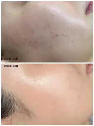 🤍【水光ピーリング】人気No.1🤍ニキビ・ニキビ跡・毛穴・黒ずみ・美白ケア🫧毛穴レス韓国肌を目指す人必見✨