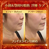 顎下 フェイスライン たるみ