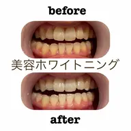 セルフホワイトニング【初回お試し価格】10分照射×2回