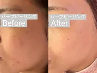 3回までモニター様【ニキビケア・肌質改善人気NO.1】剥離なしハーブピーリング