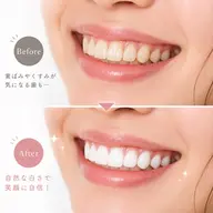 初回　セルフホワイトニング体験　10分×2照射