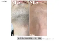 【メンズ】人気No.1ヒゲ脱毛！毎日の髭剃りの時短、肌荒れから解放されます。