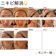 🩵女優肌ピーリング️🩵クリニックレベル🫧ニキビ・肌トラブルのない肌へ🌈韓国肌を目指す人必見✨