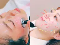【口コミ限定】美容鍼38本ダブルパルス&高周波/むくみ・くすみ改善/小顔ケア