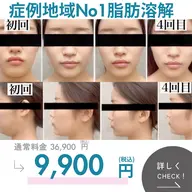 注射なし脂肪|1回でスッキリ実感 小顔