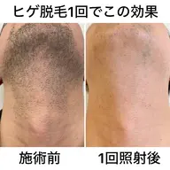 顔(女性)・髭(男性)脱毛