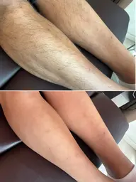 【蒲田駅徒歩2分】夏準備スタート🌻 腕＆脚　wax光脱毛で速攻ツルスベ肌へ！men's