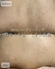 【夏までに背中美人に！】背中全体ハーブピーリング🌿剥離なし・ダウンタイムなし