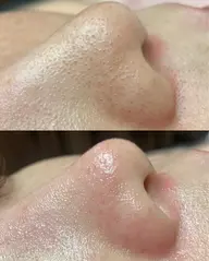 毛穴ケア