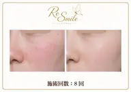 【ミニモ限定】ニキビケア通常¥10,000⇒¥5,000