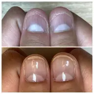 自爪育成クリアネイル