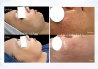 30代40代🔥引き締めx 脂肪コントロール🔥のWアプローチ！サーマリフトxスッキリ洗練小顔へ」エステ以上の効果‼️
