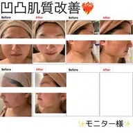 【美白×ツヤ×毛穴の改善】❄️韓国アイドルのような白玉肌へ❄️現役医療現場で使用!高濃度ピール❄️💎