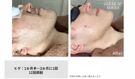 メンズヒゲ脱毛
