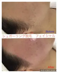 【夏前集中ケア☀️産毛・角質のケアに◎】フェイス シュガーリング脱毛＋炭酸パック