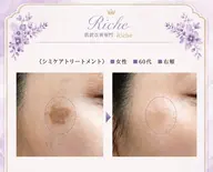 人気 1【シミ改善】徹底シミケア+高濃度ビタミン導入★ヘッドスパデコルテマッサージ付¥ 16000円→9800