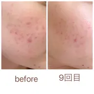 美容鍼【肌質改善】