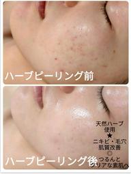 【保湿&鎮静ニキビケア】ハーブピー リング+首肩+デコルテ+ヘッド+モデリングパック 60分23000円→5980円