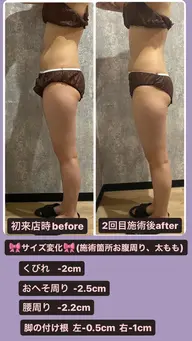 キャビテーション×リンパマッサージ