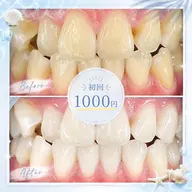 ✨【ご新規様★¥1,000】セルフホワイトニング初回体験🦷15分×2回照射💎当日特典で実質0円に🎁✨