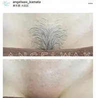 VIO+脇ワックス脱毛🌼ダブル脱毛に変更+¥4000