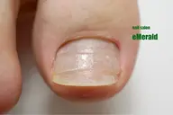 巻き爪矯正👣【軽度〜中程度の巻き爪さん向き!】