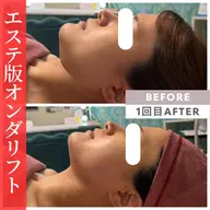 【二重顎・頬肉・口元・たるみ】エステ版オンダリフト 150kj 全顔 ¥18,000
