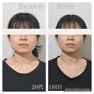 切らない小顔リフト