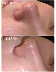 大人の肌改善⛄️水光ピーリング◎ホワイトスノーピーリング◎🤍乳酸ピーリング◎お肌に優しい⛄️くすみ、毛穴、ツヤ爆誕♡