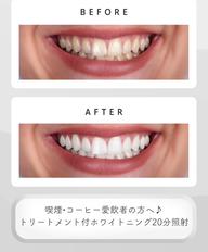 【ミニモセール】ホワイトニングお試し1回✨
