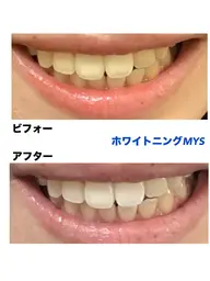 【平日限定ゲリラ割🔥】隙間時間で即実感！お試しセルフホワイトニング