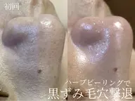 毛穴洗浄 ✖️ ヒト幹細胞鎮静パック🤍毛穴綺麗に引き締め✨当日限定70%オフ❤️‍🔥❤️‍🔥