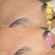 全顔フェイシャルワックス➕生プラセンタ美容液導入✨【憧れの水光ツヤ肌に🧏🏻‍♀️🩵】