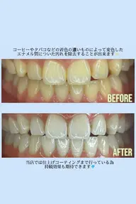 【初回限定】セルフホワイトニング2回✖️1コース✨通常5980円→2980円🦷💎