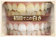 【現役歯科衛生士が徹底サポート】白さの実感が違う本格ホワイトニング¥3,980ミニモ限定