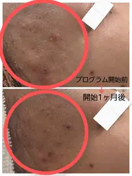 【ニキビ肌1ヶ月体験コース】 【1ヶ月分スキンケア付き】