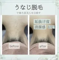 きらきらミニモ成人式前うなじ脱毛🐻脱毛未経験の方のみ対象🐻💕着物を着るなら襟足の脱毛は必須です✨
